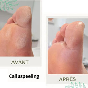 soin-pieds-calluspeeling